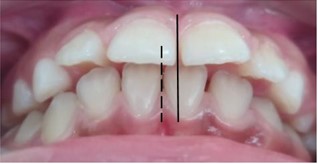 Intraoral condition: a) Simões Network 3 sectioned, b) frontal intraoral view, c) lateral intraoral view, increased overjet 8 mm, d) deviated midline before SN3, e) centered midline after SN3