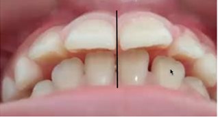 Intraoral condition: a) Simões Network 3 sectioned, b) frontal intraoral view, c) lateral intraoral view, increased overjet 8 mm, d) deviated midline before SN3, e) centered midline after SN3