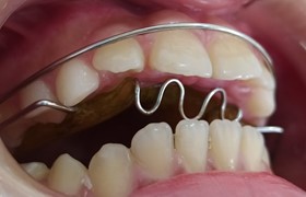 a) Simões Network 8 (SN8), b) lateral view with SN8, c) 12 mm buccal opening