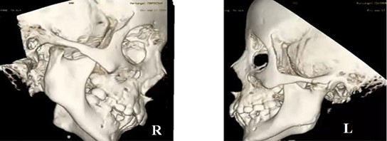 3D reconstruction cranial computed tomography. Image courtesy: Od. S. Siverio, and Od. M. Carreras. Residents of the postgraduate course of Maxillofacial Surgery of the University Military Hospital ¨Dr. Carlos Arvelo¨