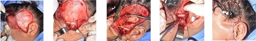 Surgical procedure. Image courtesy: Dr. Jose Gregorio Melillo. Buccomaxillofacial surgeon.