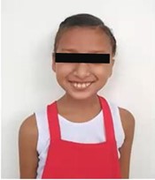 Post-surgical condition: a) frontal facial view, asymmetry, b) frontal facial view smiling,  c) right lateral facial view, d) left lateral facial view