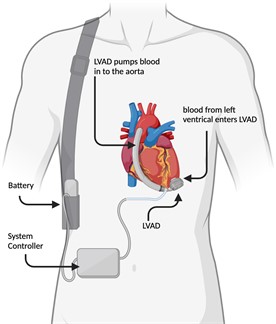 Left ventricular assist device (LVAD), adapted from UCI Health [15], by BioRender.com (2023)