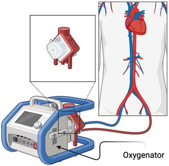 Extracorporeal Membrane Oxygenation (ECMO), adapted  from Soltes at al. [42] by BioRender.com (2023)