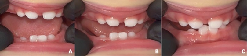 a) Maximum mouth opening when crying, b) intermediate mouth closure, c) final mouth closure