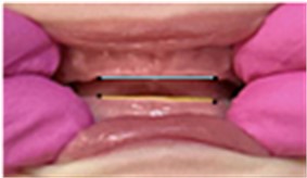 Reference points: lateral grooves of the upper gingival margin and the projection  of the upper straight line of the upper edge onto the lower edge