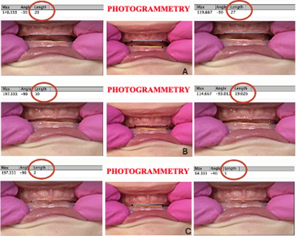 Distance between the arches (right and left side) at maximum opening, intermediate, and closed positions (A, B, C,). In A, a distance of 20 pixels on the right side and 27 pixels on the left side is observed. In B, 10 pixels on the right side and 19 pixels on the left side. In C, 2 pixels on the right side and 5 pixels on the left side. There is a greater approximation of the hemimaxilla with the right hemimandible, that is, with greater inclination on the right side, the side of the torticollis