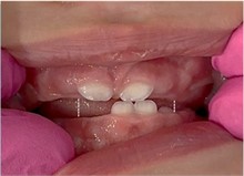 Baby with front teeth present. The reference used was the point determined at the distal end of the last erupting and/or erupted tooth, projected against the antagonist margin, on each side