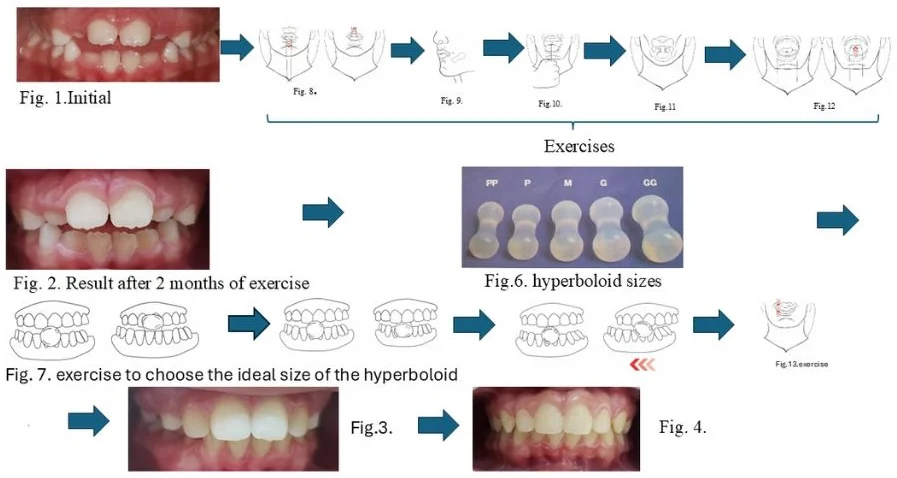 Use of hyperboloid as an adjunct in functional jaw orthopedics – case report