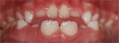 08/2020, Initial intraoral frontal view of treatment with hyperboloid exercises