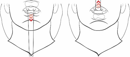 Toning the upper and lower central orbicularis oris for 3 minutes, 3x a day,  place the hyperboloid on the vestibular of the upper teeth, seal the lips  and pull downwards and repeat on the lower one, pulling upwards