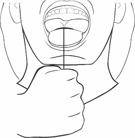 Toning the tongue with elastic, 10 movements 3x a day, tie a dental floss  to the 3/8 orthodontic elastic at one end, place the tongue inside the elastic  and the most posterior one and pull it forward until it comes out 10 times