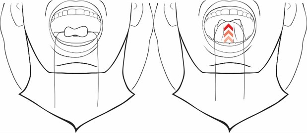 Stimulation of the tongue with a hyperboloid, place the hyperboloid on the tongue and pull it, closing the mouth, touching the palate and applying force with the tip of the tongue