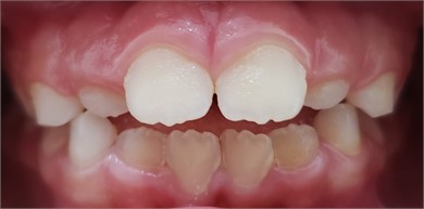 10/2020 intraoral frontal view of the results achieved in 2 months of exercises