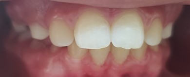 03/2021, intraoral frontal view of the results achieved in 5 months of exercises