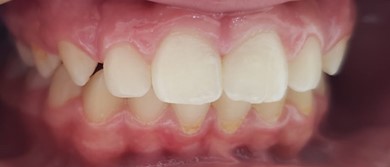 05/2023, intraoral frontal view after return after 2 years and 2 months