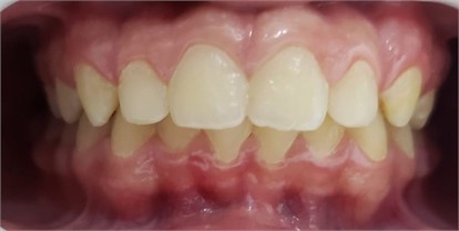 07/2024 SN 3 just to sleep and continue with alternating unilateral chewing exercises. Alternating unilateral chewing exercises were prescribed based on the circuit theory of occlusal forces