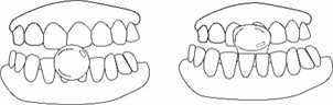 Movements required to choose the ideal size of the hyperboloid for chewing.