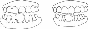 Movements required to choose the ideal size of the hyperboloid for chewing.