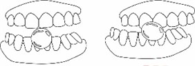 Movements required to choose the ideal size of the hyperboloid for chewing.