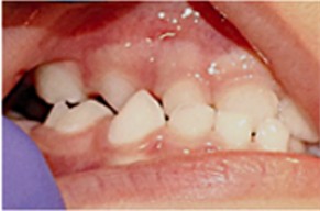 Patient with unilateral right anterior/posterior crossbite