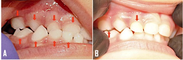 1st stage: Occlusal adjustment by grid and addition of resin. In A, Grid was performed on the palatal surface of teeth 51/52/53; palatal cusp of tooth 54 and buccal surface of teeth 81/82/83/84. In B, addition of resin was carried out on the lingual cusp of tooth 84 and Inclined Plane on the buccal surface of tooth 52