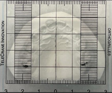 A dotted line was drawn in the region of the palatal raphe to the most distal point  of the incisive papilla and around the lingual surface of the second molars