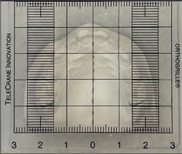 Hemi-maxilla with corrected distalized sector 63-65