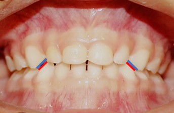 3rd stage: Occlusal adjustment by grid. The criteria for occlusal adjustments by grid were based on mandibular dynamics (opening/closing, right and left laterality and protrusion movements). The grid was performed on the mesial side of teeth 53/63 and on the distal side of teeth 73/83