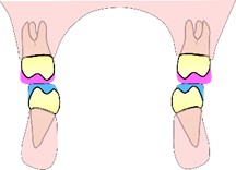 Posterior Planas direct tracks and the anterior stop  on the palatal surfaces of the upper incisors (in green)