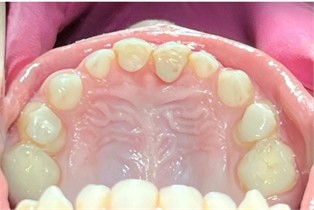 Case 2: Occlusal and frontal photo six months after installation.  A significant change in the maxilla, especially in its transverse diameter, can be observed