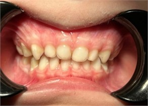 Case 2: Occlusal and frontal photo six months after installation.  A significant change in the maxilla, especially in its transverse diameter, can be observed