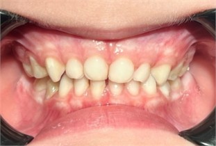 Case 2: frontal view one and a half years after the installation  of the modified Planas direct tracks with anterior stops