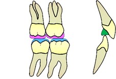 Posterior Planas direct tracks and the anterior stop  on the palatal surfaces of the upper incisors (in green)