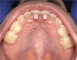 Case 1: Installation of the bite block on the palatal surfaces of the upper teeth and the occlusal surfaces of the second molars (occlusal view) and immediate post-installation frontal image