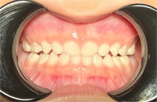 Case 1: Installation of the bite block on the palatal surfaces of the upper teeth and the occlusal surfaces of the second molars (occlusal view) and immediate post-installation frontal image