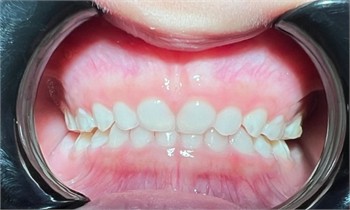 Case 1: frontal view one year after the installation  of the modified Planas direct tracks with anterior stops