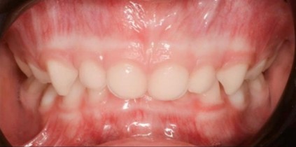 Case 2: initial frontal photo showing the deep bite with complete coverage of the lower incisors