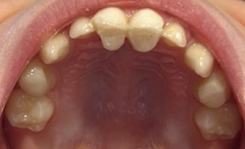 Case 2: installation of the bite stop on the palatal surfaces of the upper incisors and the occlusal surfaces of the first molars (occlusal view) and immediate post-installation frontal image