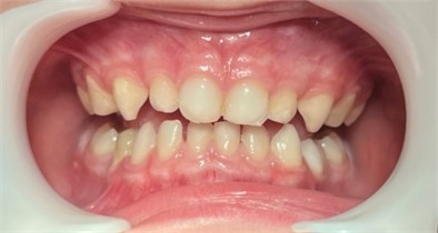 Case 2: installation of the bite stop on the palatal surfaces of the upper incisors and the occlusal surfaces of the first molars (occlusal view) and immediate post-installation frontal image