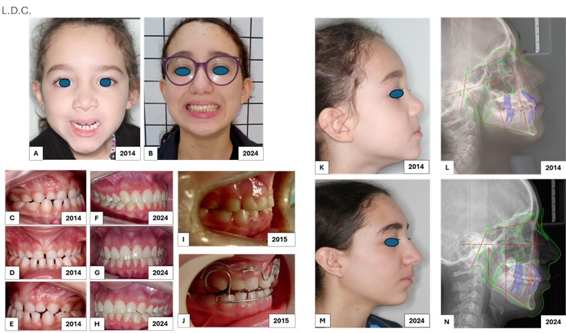 Patient L.D.C.: a) frontal extraoral photo, 4 years and 8 months, 2014; b) frontal extraoral photo, 15 years old, 2024; c) right lateral intraoral photo, severe maxillary growth deficiency 2014; d) frontal intraoral photo; e) left lateral intraoral photo; f) right lateral intraoral photo, harmonic relationship between the jaws, 2024; g) frontal intraoral photo; h) left lateral intraoral photo; i) adaptation of resin in the palatal region of the upper incisors with an inclination of 35 degrees, indirectly, performed first on the working model and transferred to the tooth, these 35 degrees are measured according to the long axis of the tooth crown and allow the lower incisors to be positioned correctly in relation to the upper incisors, reestablishing the correct DA, Determined Area.; j) Planas’ Special Flat Indirect Tracks (PIPE) with Äeschler Arch and Upper Lip Shield; k) extraoral photo in right side profile; l) initial lateral teleradiographs, m) extraoral photo in right lateral profile; n) final lateral radiograph