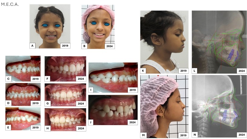 Patient M.E.C.A.: A) frontal extraoral photo, 3 years and 11 months, 2019; B) frontal extraoral photo, 9 years old, 2024; C) right lateral intraoral photo, maxillary growth deficiency; D) frontal intraoral photo; E) left lateral intraoral photo; F) right lateral intraoral photo, harmonic relationship between the jaws; G) frontal intraoral photo; H) left lateral intraoral photo; I) left lateral intraoral photo; J) adaptation of resin in the palatal region of the upper incisors with an inclination of 35 degrees, indirectly, performed first on the working model and transferred to the tooth, these 35 degrees are measured according to the long axis of the tooth crown and allow the lower incisors to be positioned correctly in relation to the upper incisors, reestablishing the correct DA, Determined Area.; K) extraoral photo in right side profile; L) initial teleradiography in the right lateral norm; M) extraoral photo in right lateral profile; N) final radiograph in right lateral rule