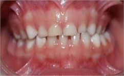 Unilateral left crossbite – GRM 6 years 3 months of treatment