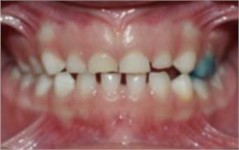 Unilateral left crossbite – GRM 6 years 3 months of treatment