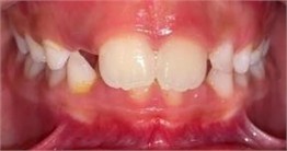 Class II bite II – SN 8 years 3 months of treatment