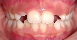 Class II bite II – SN 8 years 3 months of treatment