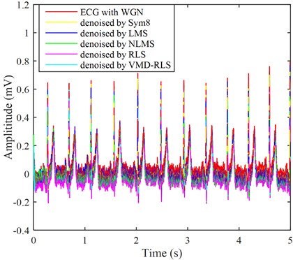 The ECG signals with Gaussian white noise were denoised by four methods