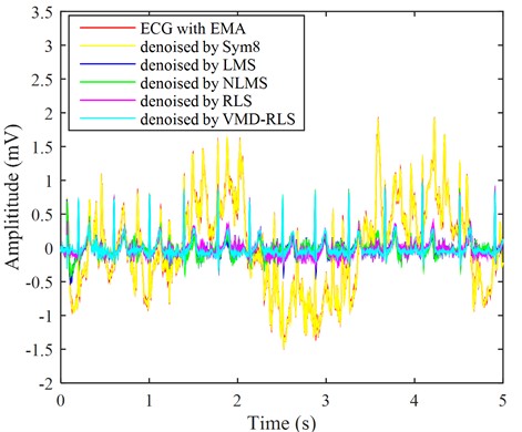 The ECG signals with electrode movement noise were denoised by four methods