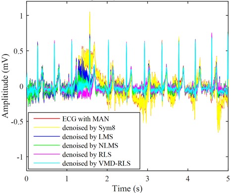 The ECG signals with muscle artifacts noise were denoised by four methods