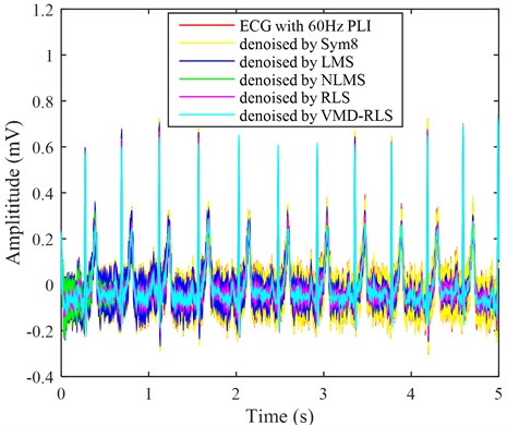 The ECG signals with power line interference noise were denoised by four methods